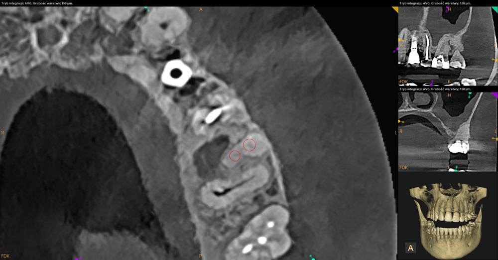 Tomografia CBCT złamane narzędzie w kanale zęba