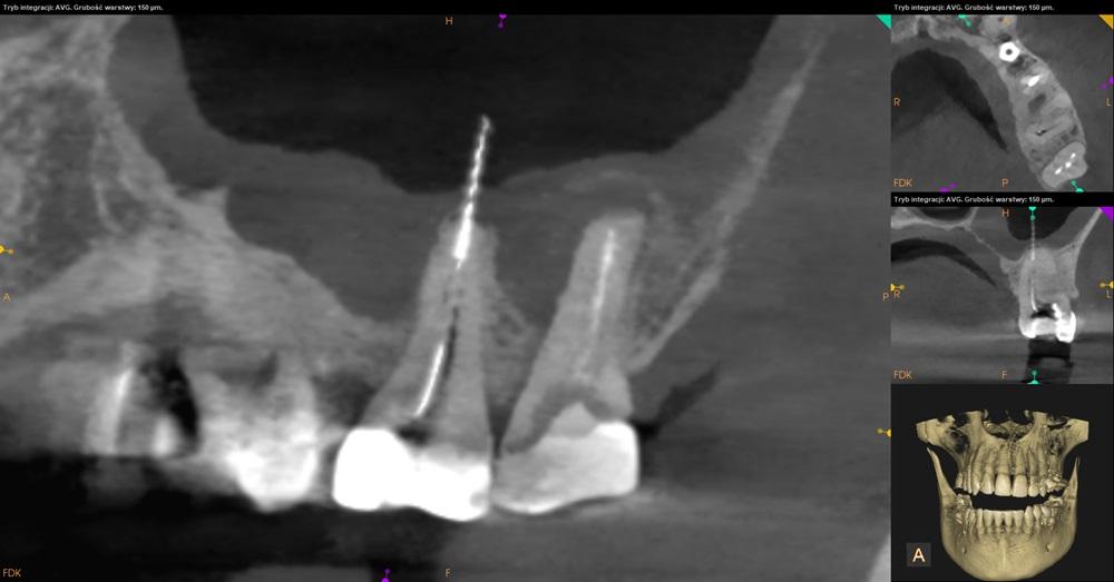 Tomografia CBCT złamane narzędzie w kanale zęba