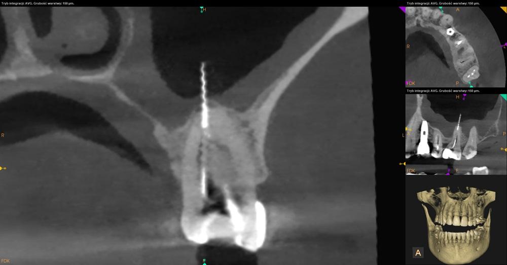 Tomografia CBCT złamane narzędzie w kanale zęba